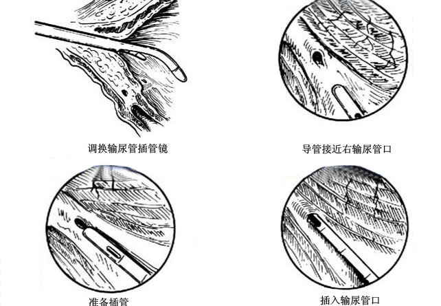 图解膀胱镜检查术过程