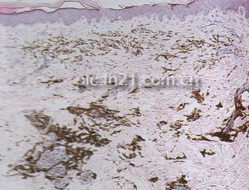 蓝痣病理表现_飞华健康网