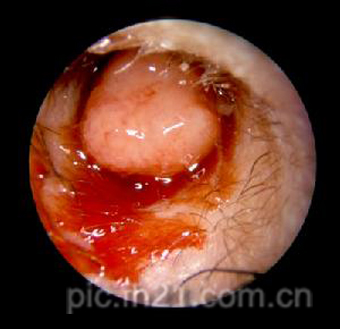 胆脂瘤型中耳炎图