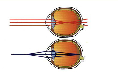 屈光性近视眼的结构图
