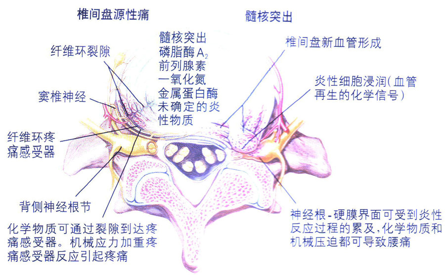 腰椎间盘突出 症是纤维环破裂后髓核突出压迫神经根造成以腰腿痛为