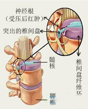 颈椎病3种类型的图解