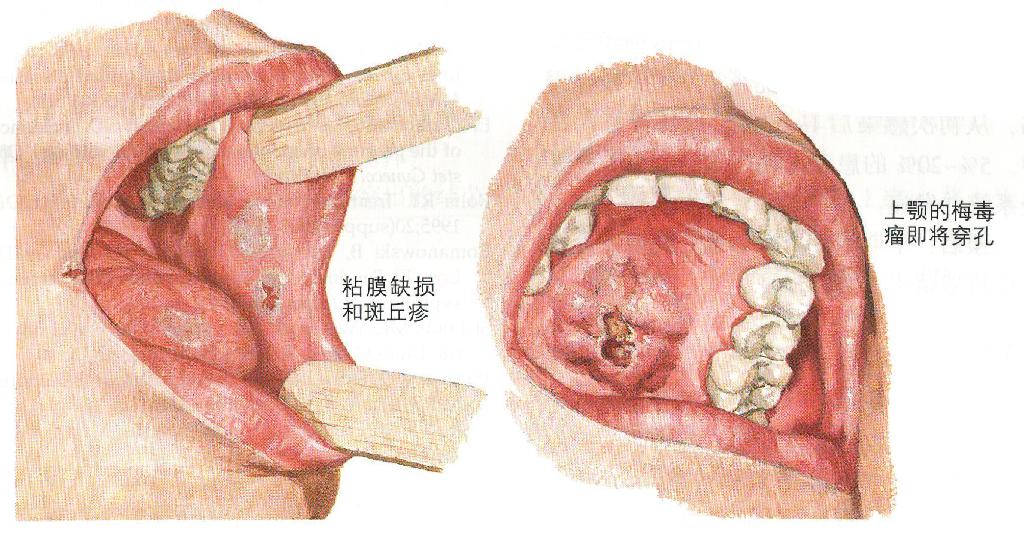 淋病梅毒 检查价格_抗梅毒类价格_抗糖尿病药物金刚烷类