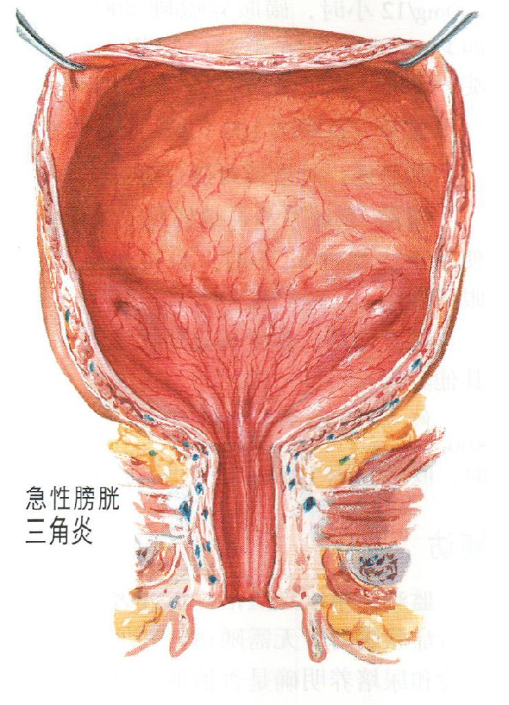 急性膀胱炎的临床表现