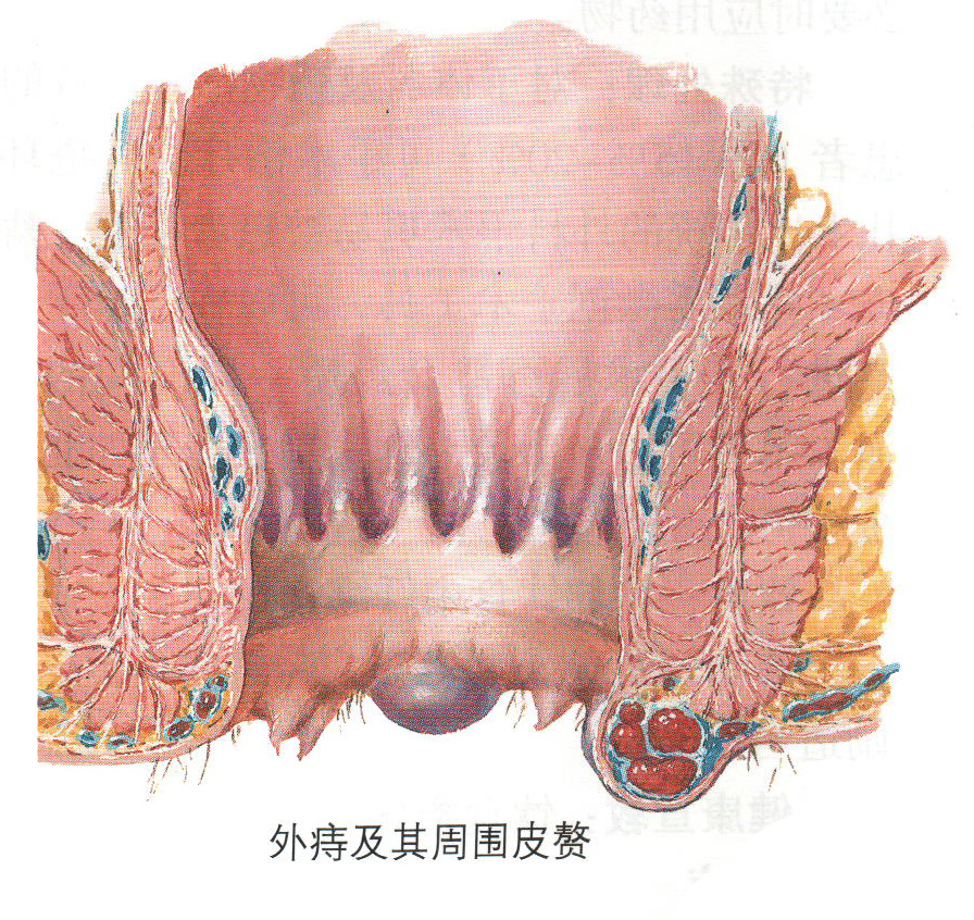 痔疮的分类临床表现