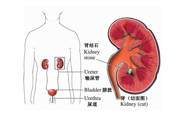 引起肾结石的原因