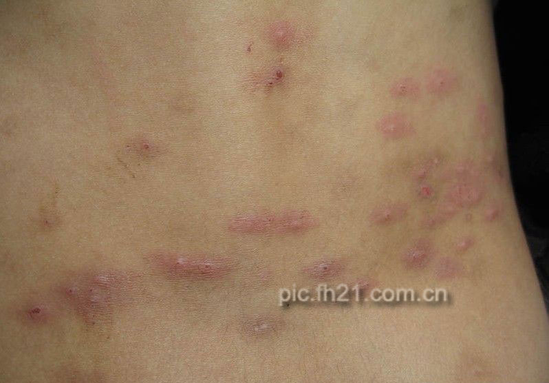 特别是蚊子,跳蚤等的叮咬,引起的皮肤某些部位的丘疹,丘疱疹,水疱等