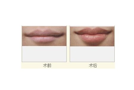 人体丰唇手术过程图