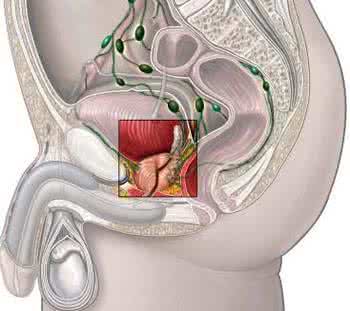 前列腺结核的中医治疗