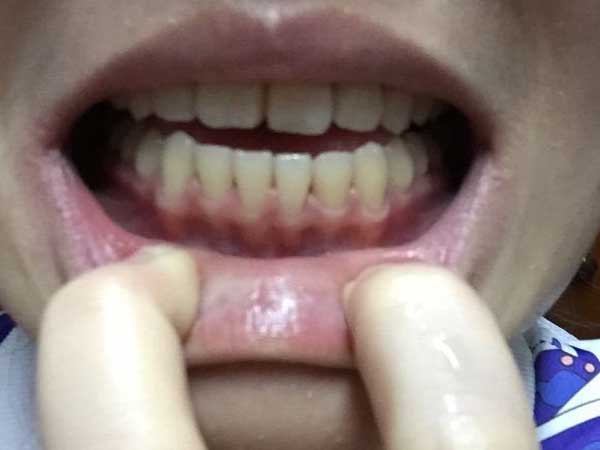 你了解牙龈萎缩吗