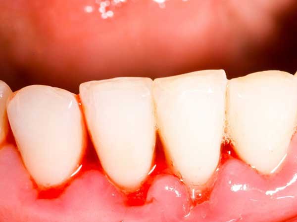 牙龈萎缩早期的症状表现是什么