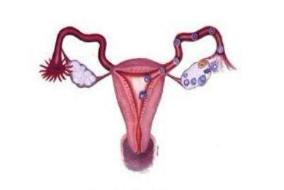 输卵管堵塞必须做试管婴儿吗