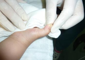 孩子大拇指腱鞘炎治疗方法