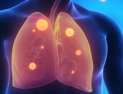 治疗过敏性哮喘中成药的药方都有什么
