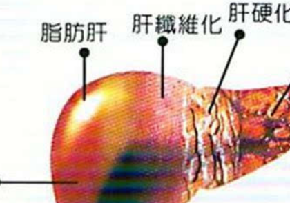 肝硬化结节图片有什么表现