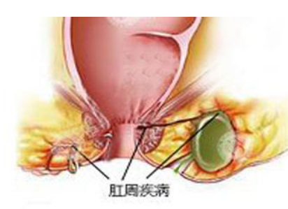 肛周脓肿需要注意的日常护理要点