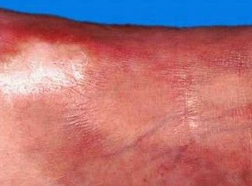 得了硬皮病会死吗