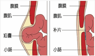 中医治疗小儿疝气的效果好吗