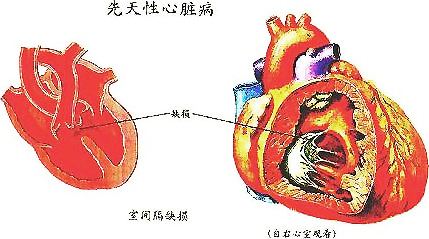 如何预防儿童小儿先天性心脏病