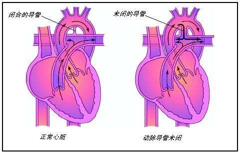 动脉导管未闭的特点
