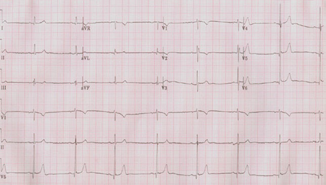 窦性心动过缓危害有多大