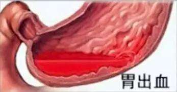 胃出血常见临床症状是什么