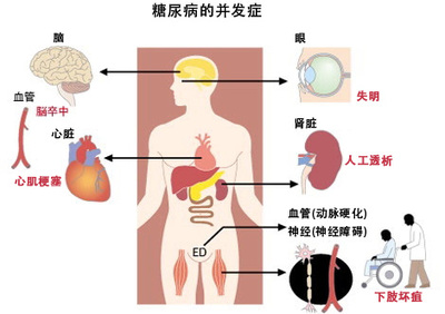 得了2型糖尿病应该用什么药