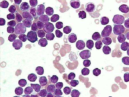 急性淋巴细胞白血病最详细的介绍_飞华健康网