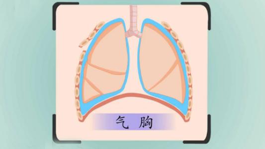 气胸适合用什么方法治疗