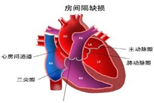 房间隔缺损怎么样根治