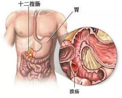 十二指肠溃疡治疗方法推荐