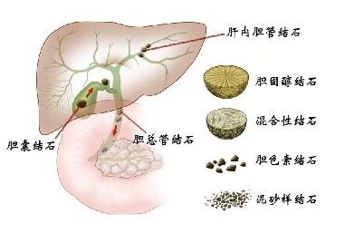 最先进的肝内胆管结石诊断方法是什么