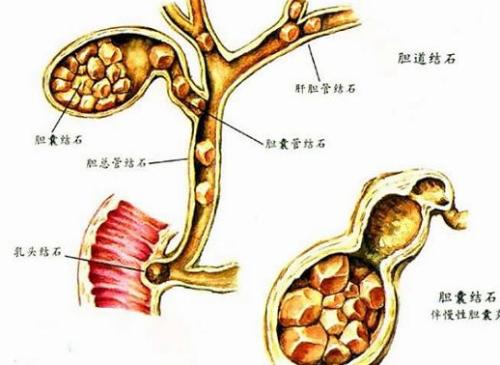肝内胆管结石的症状特点是什么