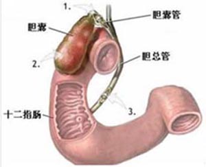 > 外科 > 肝胆外科 > 肝内胆管结石 > 预防