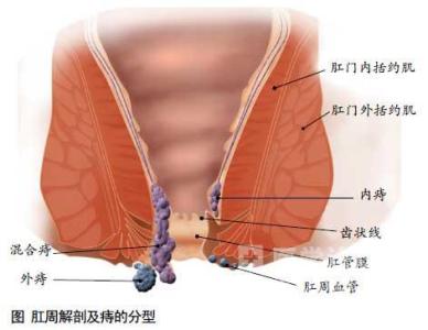 三甲医院治内痔要多少钱