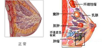 引起乳腺囊肿的五大原因