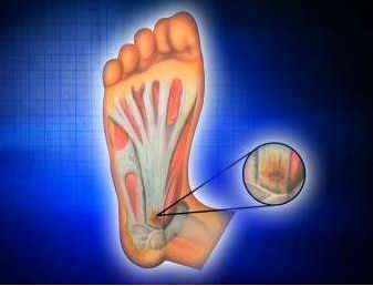 足底筋膜炎应该如何护理