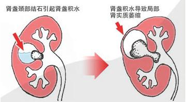输尿管结石具体有什么症状