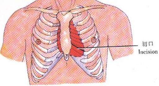 肋软骨炎以第2,3肋软骨最常见,也可侵犯胸骨柄,锁骨内侧和前下诸肋