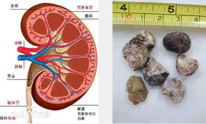 尿结石患者的症状表现