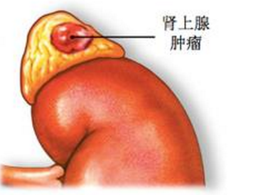 肾上腺肿瘤治疗后防止复发的办法是什么呢