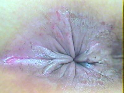 肛周湿疹图片是什么样的