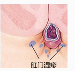 肛周湿疹图片大全_肛周湿疹怎么治疗