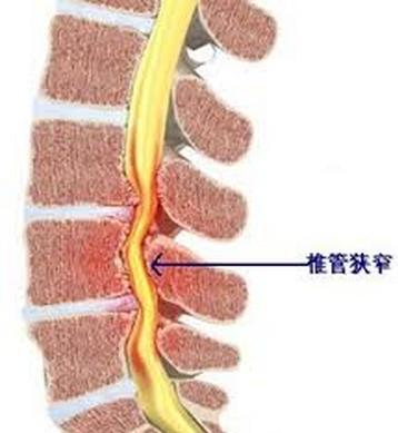 什么是椎管狭窄