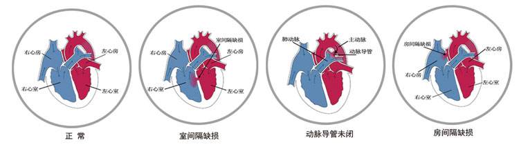 法洛四联症是什么意思