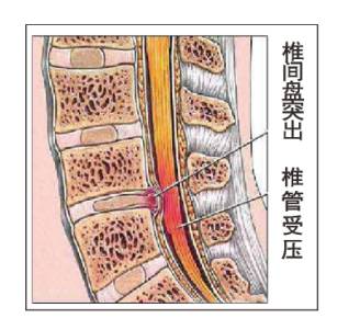突间距小,椎板间隙狭窄;侧位片示椎体后缘有骨嵴凸起,椎间关节肥大,椎