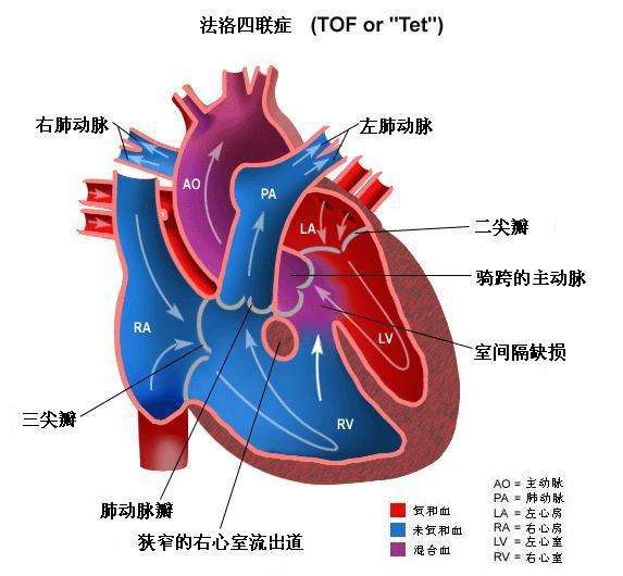 法洛四联症病因