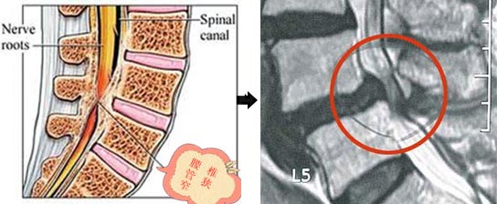 老年人椎管狭窄怎么办
