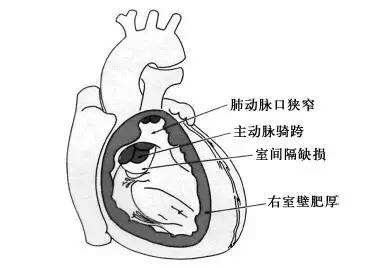 法洛四联症什么时候手术最好