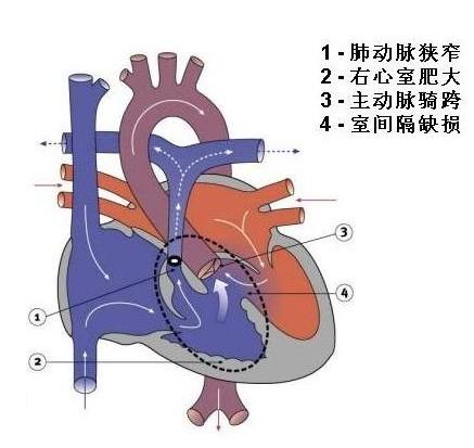 法洛四联症有哪些症状表现